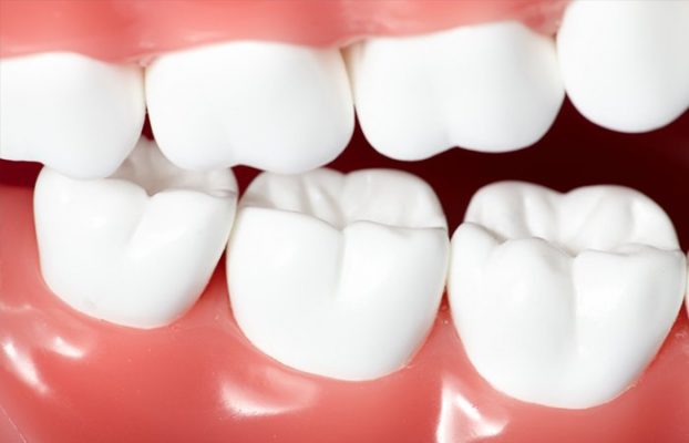 boc rang su gia bao nhieu