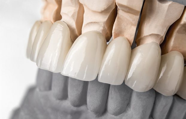 cac phuong phap boc rang su hien nay