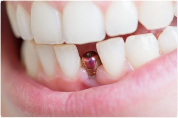 Trồng răng Implant mới nhất 2022