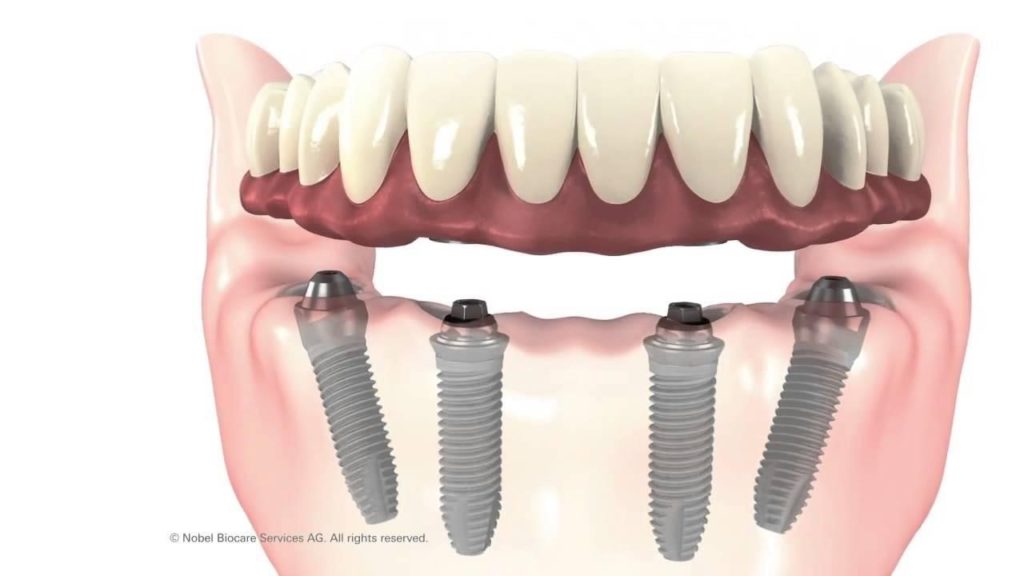 cay phep implant all on 4