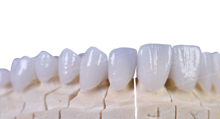 vật liệu răng sứ