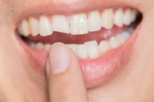 Răng sứ bị sứt ảnh hưởng như thế nào?