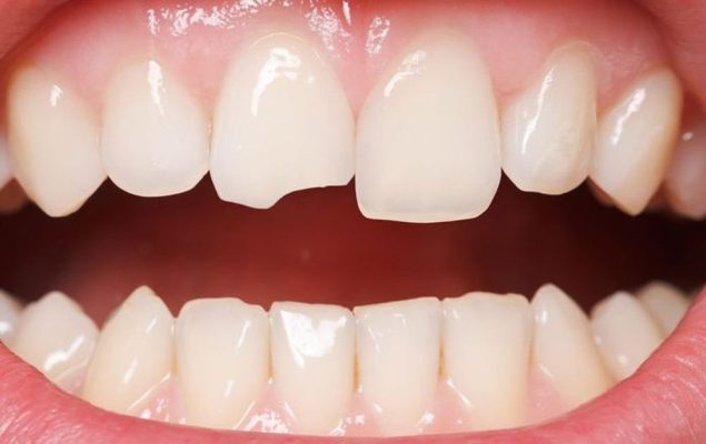 Nguyên nhân nào khiến răng sứ bị sứt mẻ?