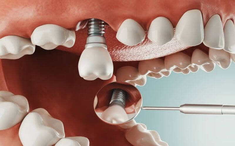 trồng răng implant da lat