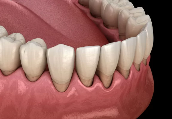 Tụt lợi khi niềng răng là gì
