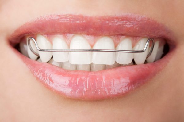 Có cần thiết phải đeo hàm duy trì sau khi niềng răng không?