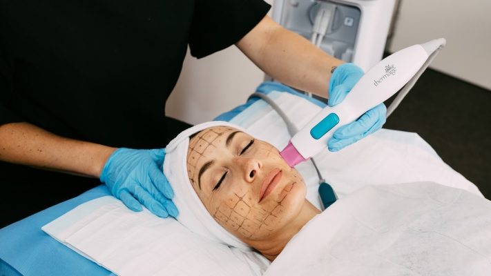 so sánh thermage và ultherapy
