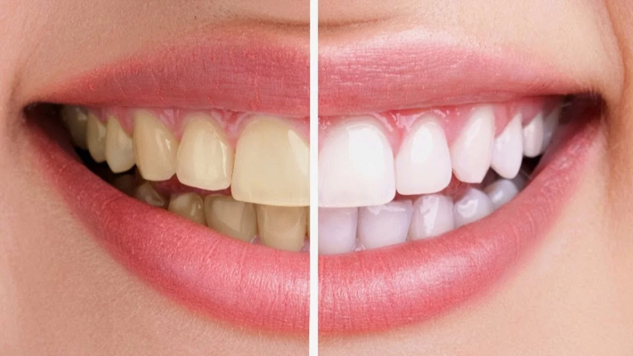 Làm trắng răng sau khi niềng răng bằng tẩy trắng răng