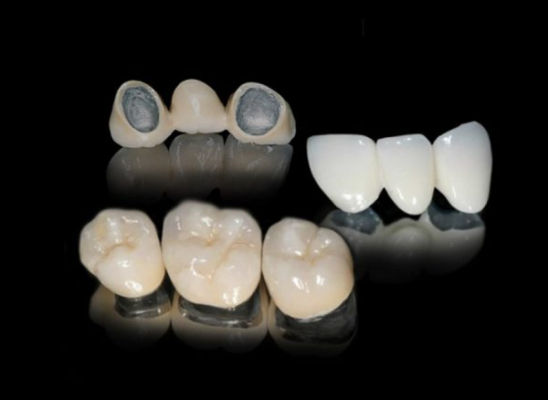 Các dòng răng sứ hiện nay: răng sứ kim loại
