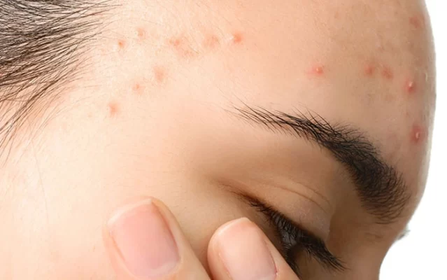 hết mụn tuổi dậy thì