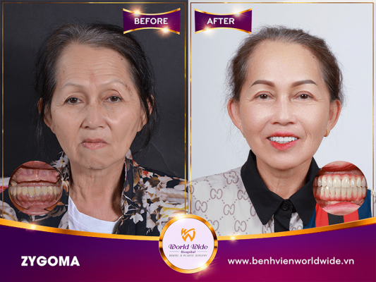 khách trồng răng implant - Zygoma (7)