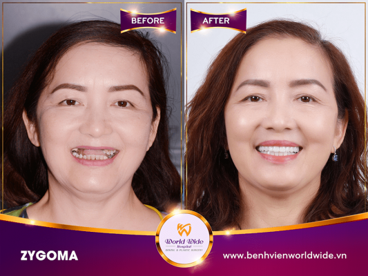 khách trồng răng implant - Zygoma (4)