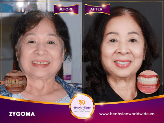 khách trồng răng implant - Zygoma (1)
