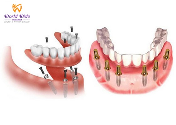 Implant cho người mất răng toàn hàm implant