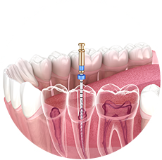 THE PROCESS OF BRACES INSTALLATION điều trị tủy răng