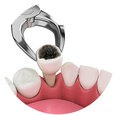 THE PROCESS OF BRACES INSTALLATION nhổ răng