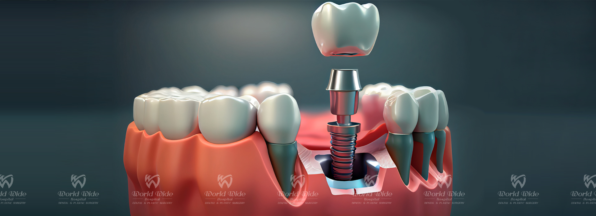 Implant Procedure mô hình trồng implant