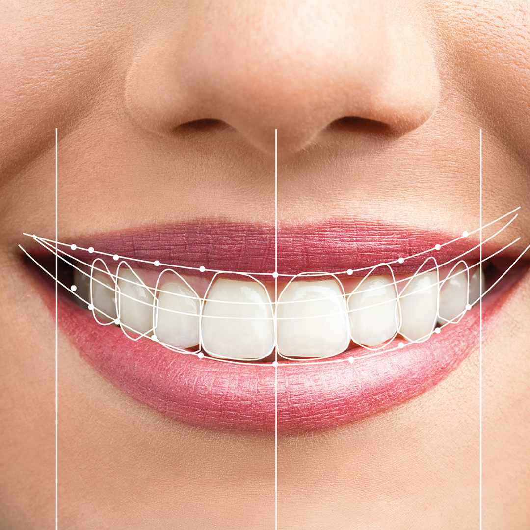 Những điều cần biết về cấy ghép Implant phần mềm phân tích nụ cười