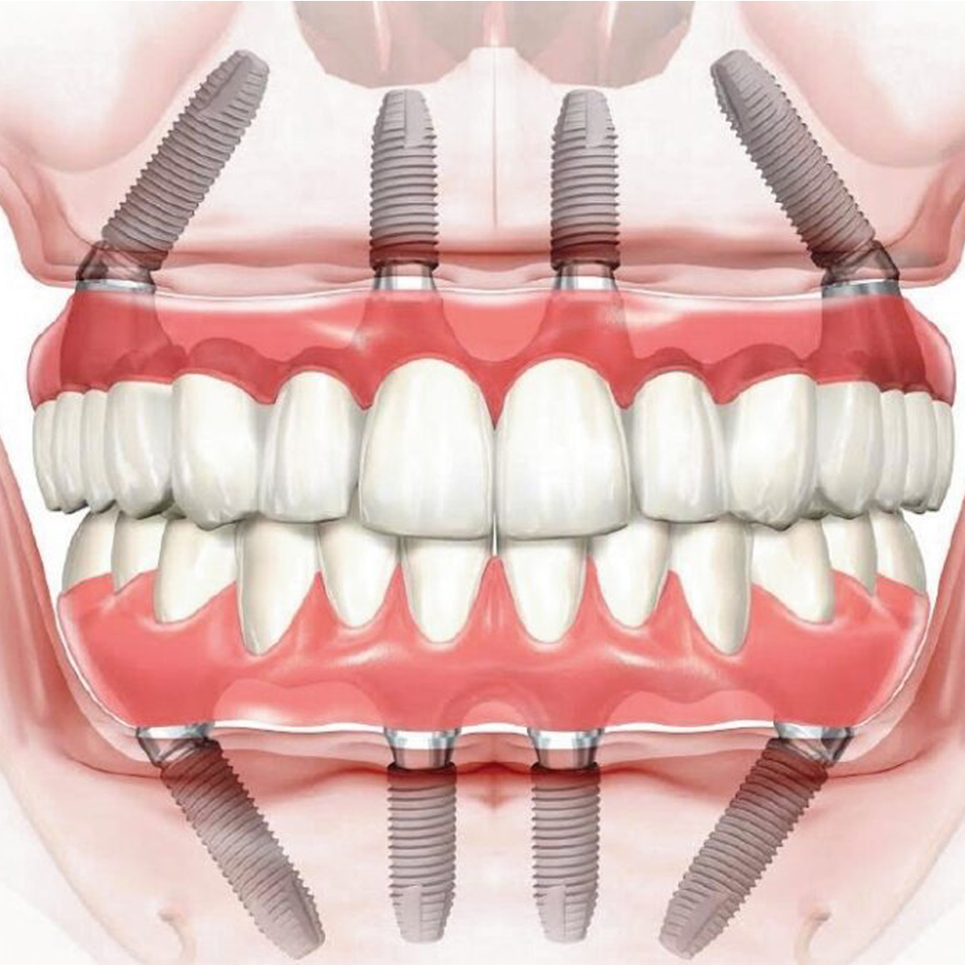 TRỒNG RĂNG IMPLANT TOÀN HÀM all on 4 all on 6