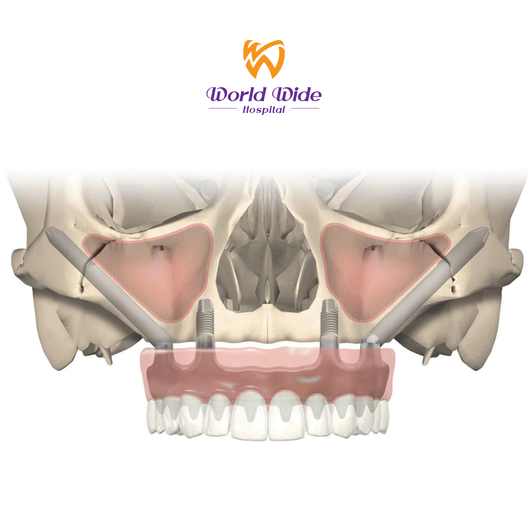 2.-zygoma-implant.jpg