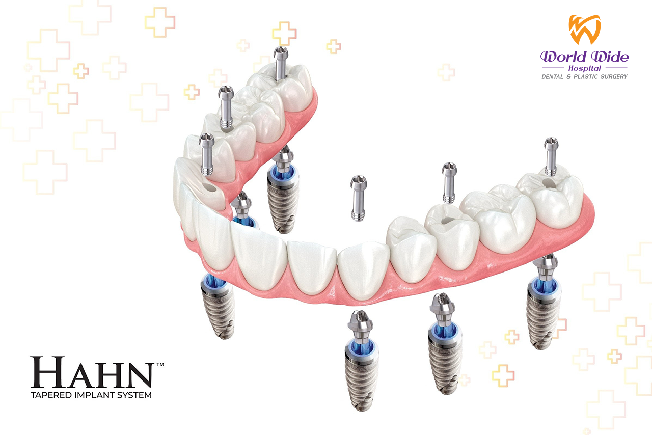 Hahn implant được cấu tạo như thế nào