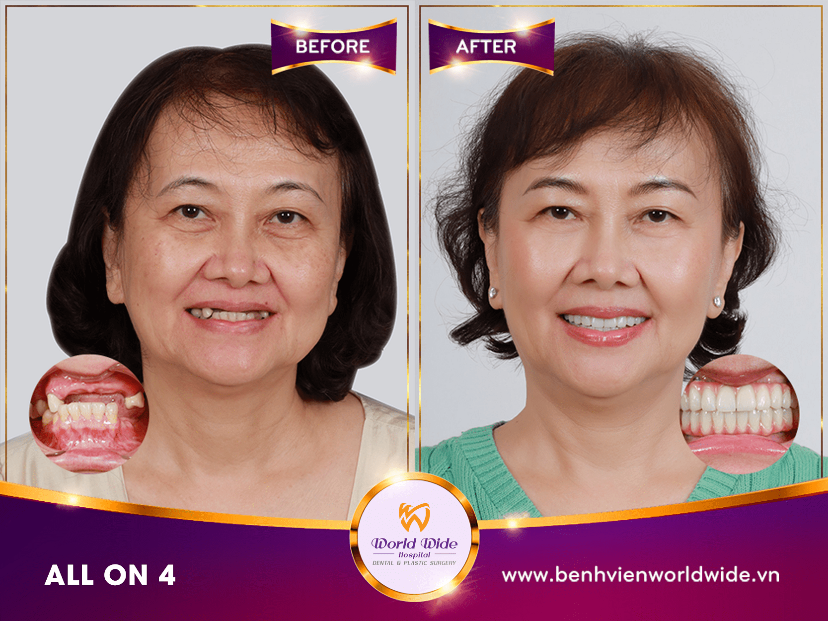 Những điều cần biết về cấy ghép Implant case before after tại bệnh viện răng hàm mặt Worldwide