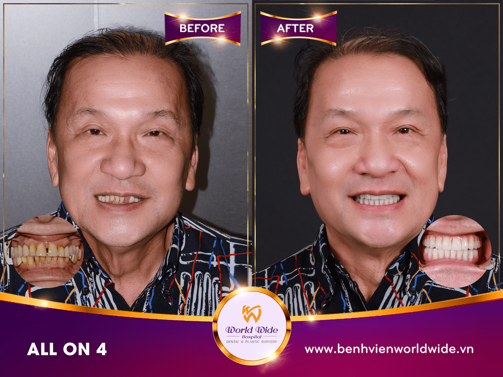 Những điều cần biết về cấy ghép Implant case before after tại bệnh viện răng hàm mặt Worldwide