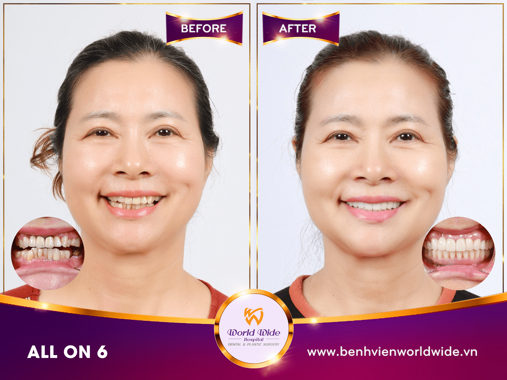 Những điều cần biết về cấy ghép Implant case before after tại bệnh viện răng hàm mặt Worldwide