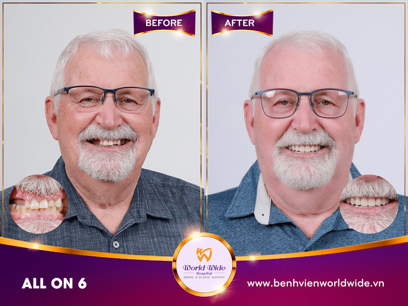 implant all on 6 tại bệnh viện răng hàm mặt Worldwide