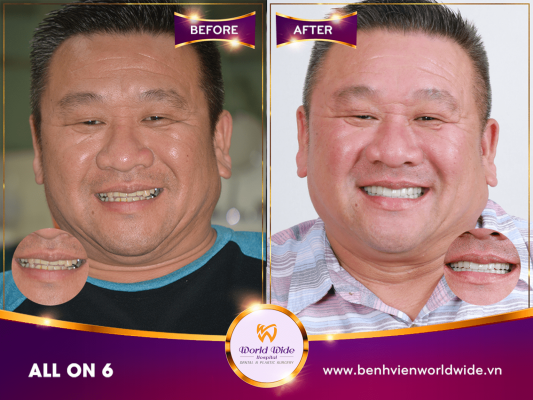 Implant Procedure case study về all on 6
