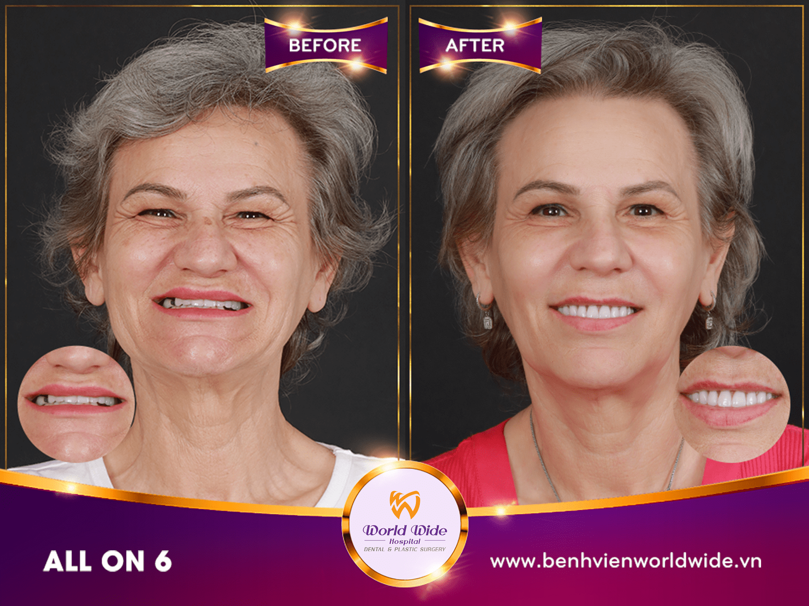 điều trị implant tại bệnh viện Worldwide