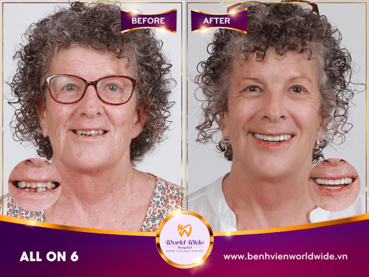 Implant Procedure all on 6 tại worldwide