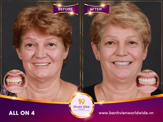 Implant Procedure case before after tại bệnh viện răng hàm mặt Worldwide