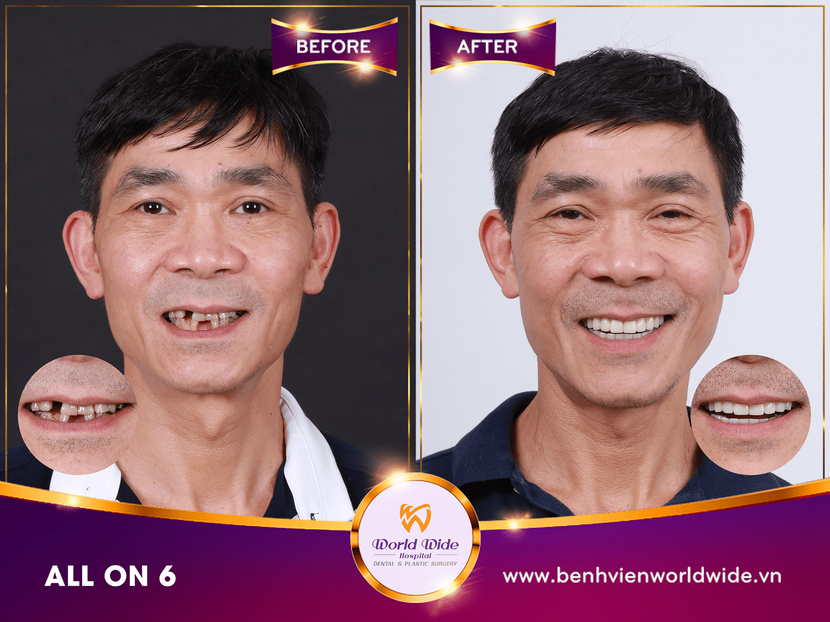 Những điều cần biết về cấy ghép Implant before after all on 6