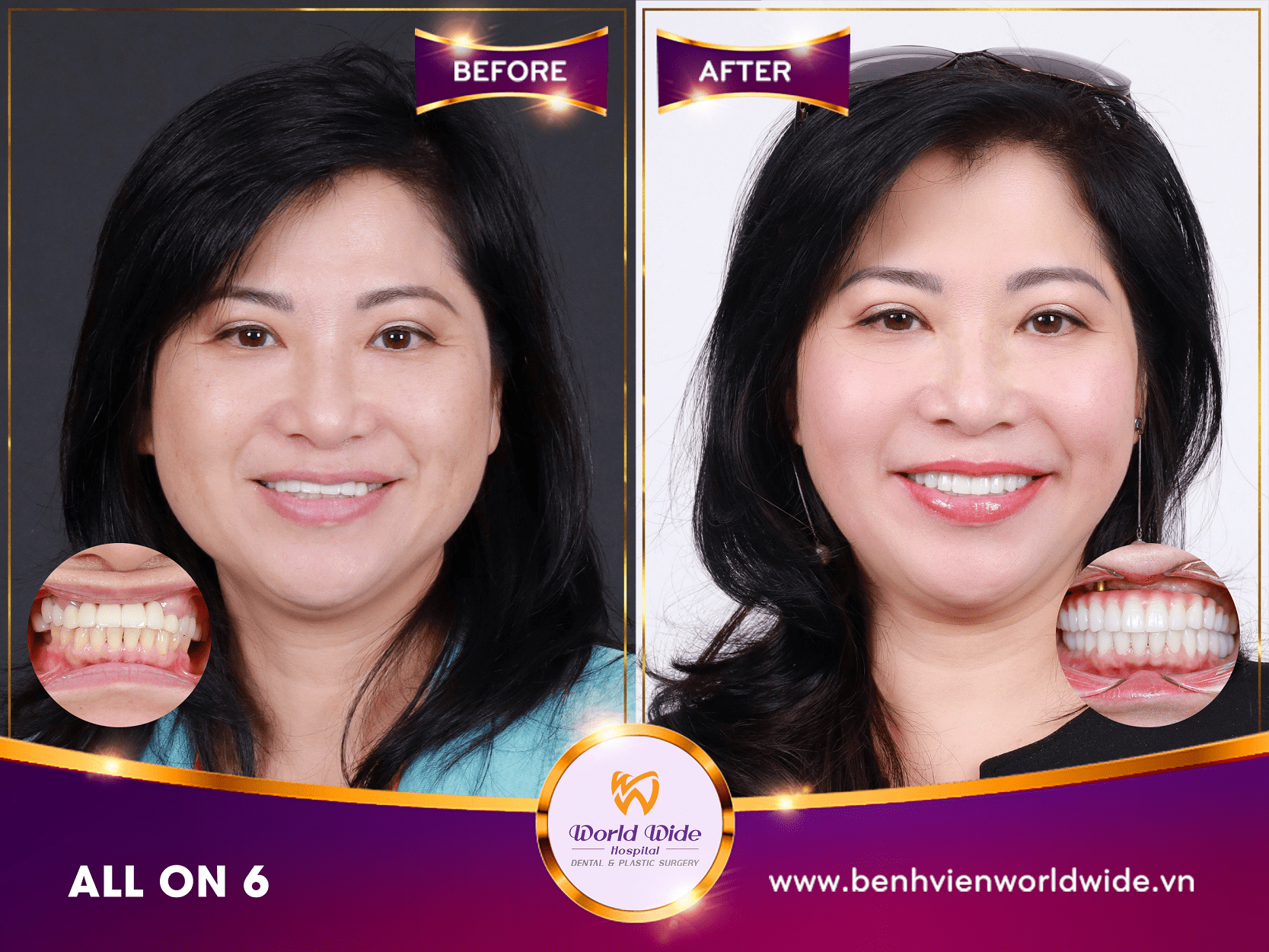 Những điều cần biết về cấy ghép Implant case before after tại bệnh viện răng hàm mặt Worldwide