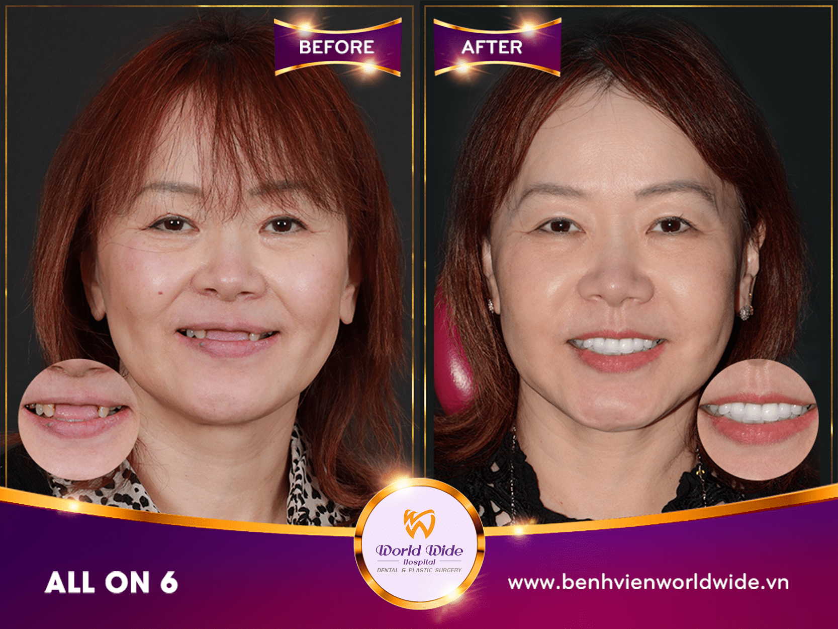 Những điều cần biết về cấy ghép Implant case before after tại bệnh viện răng hàm mặt Worldwide