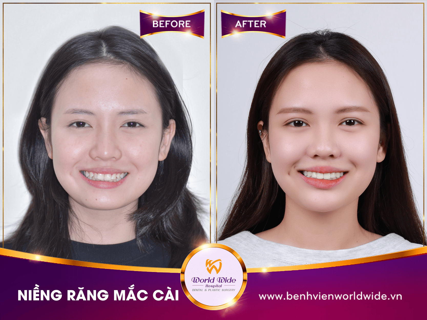 Các loại mắc cài niềng răng niềng răng mắc cài (7)
