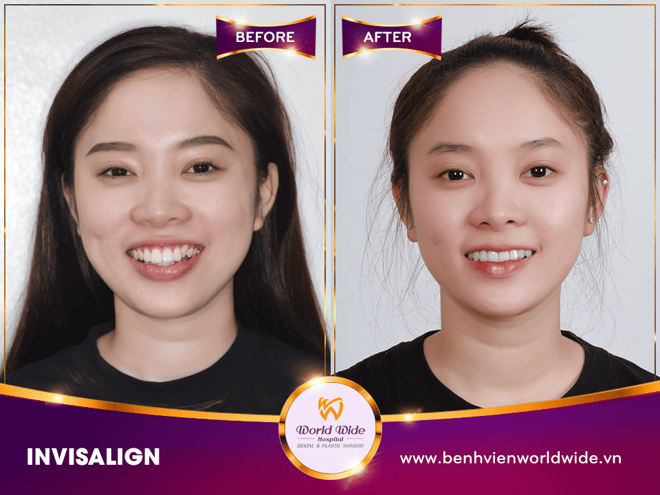 Trước và sau khi niềng răng Invisalign