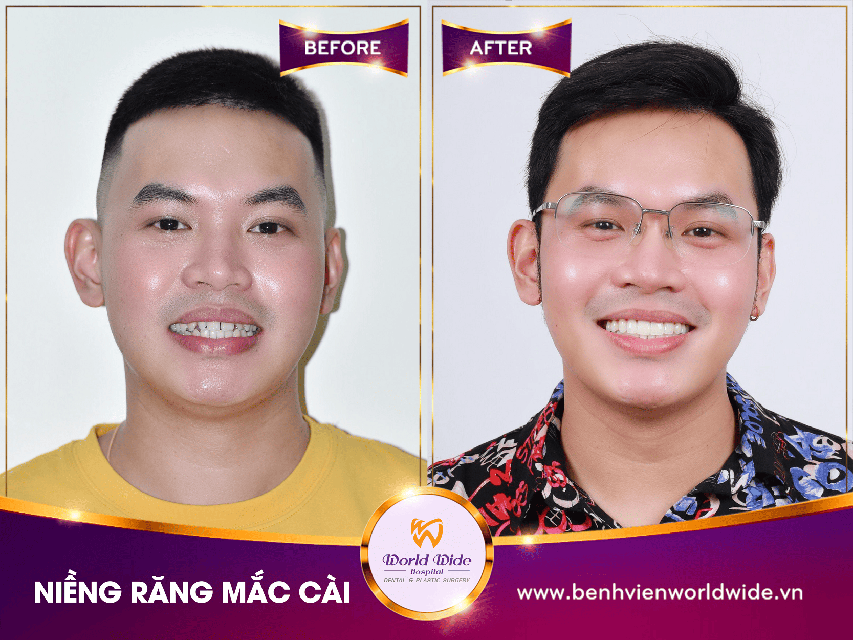 Các loại mắc cài niềng răng niềng răng mắc cài (2)