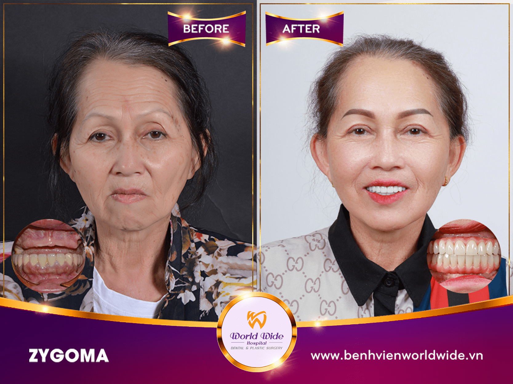 Những điều cần biết về cấy ghép Implant zygoma