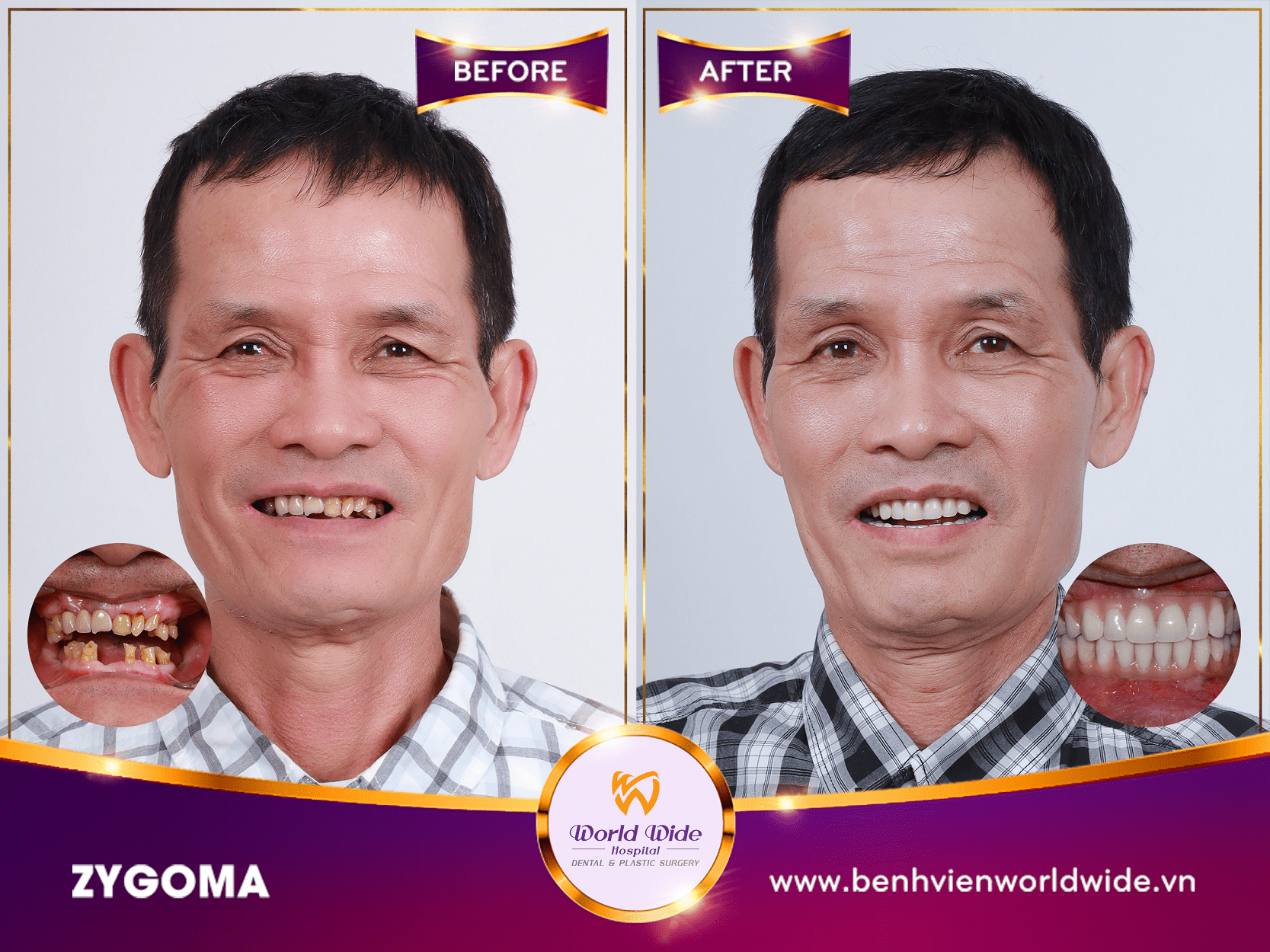 Những điều cần biết về cấy ghép Implant zygoma