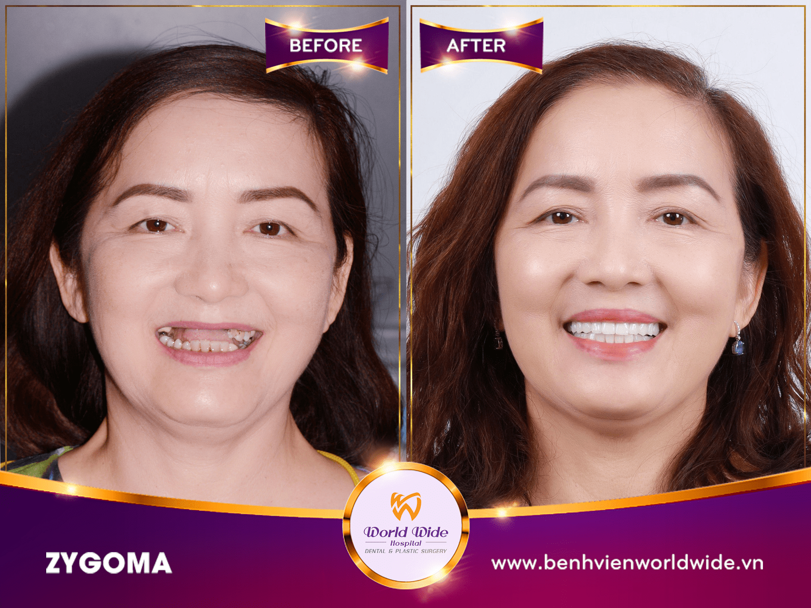 Những điều cần biết về cấy ghép Implant zygoma