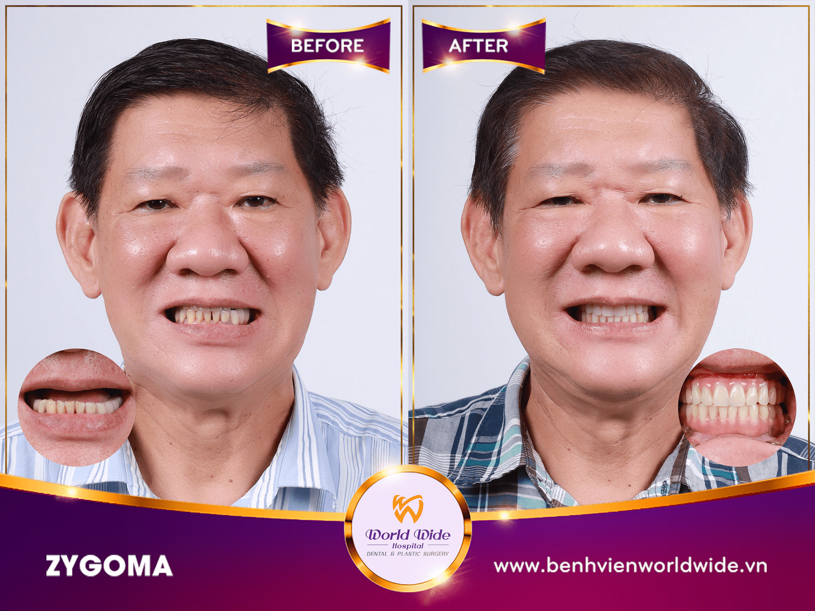 Những điều cần biết về cấy ghép Implant zygoma