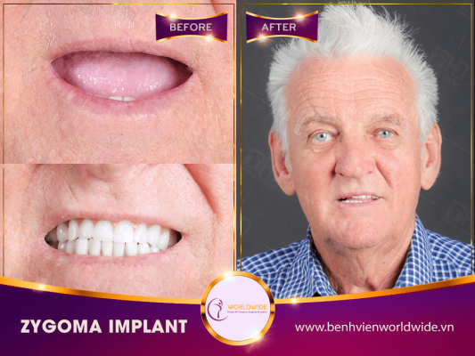 All-on-4-WW-Deborah-min