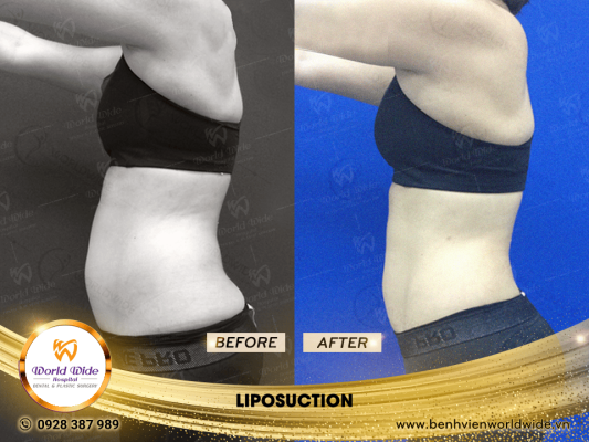 Tummy Tuck - Worldwide Hospital LIPOSUCTION