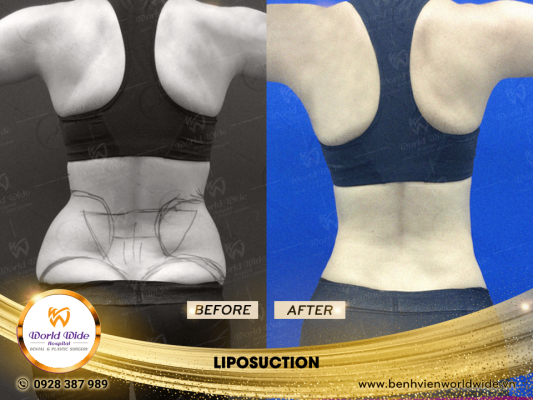 Tummy Tuck - Worldwide Hospital LIPOSUCTION