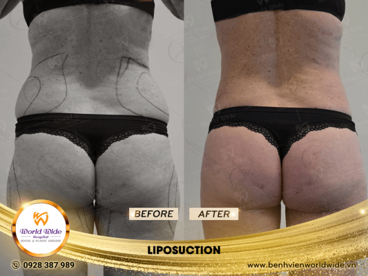 Tummy Tuck - Worldwide Hospital LIPOSUCTION