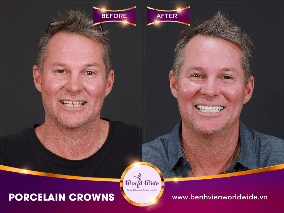 DENTAL CROWNS, VENEERS & BRIDGES PETER LEE