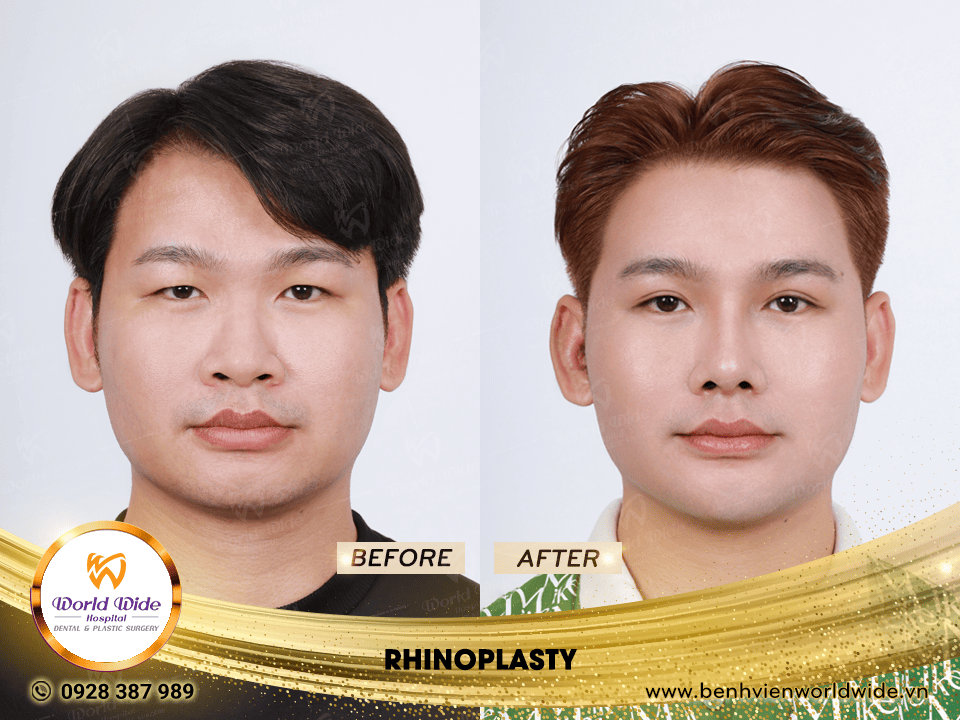 Self cartilage lifting RHINOPLASTY