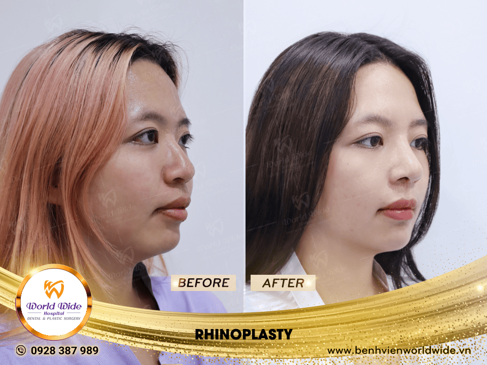 Self cartilage lifting RHINOPLASTY